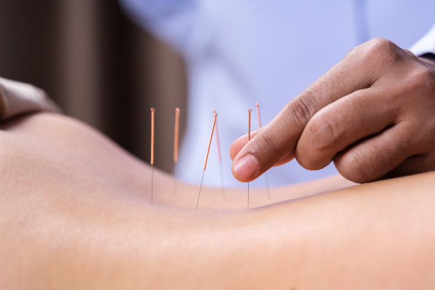 definition acupuncture